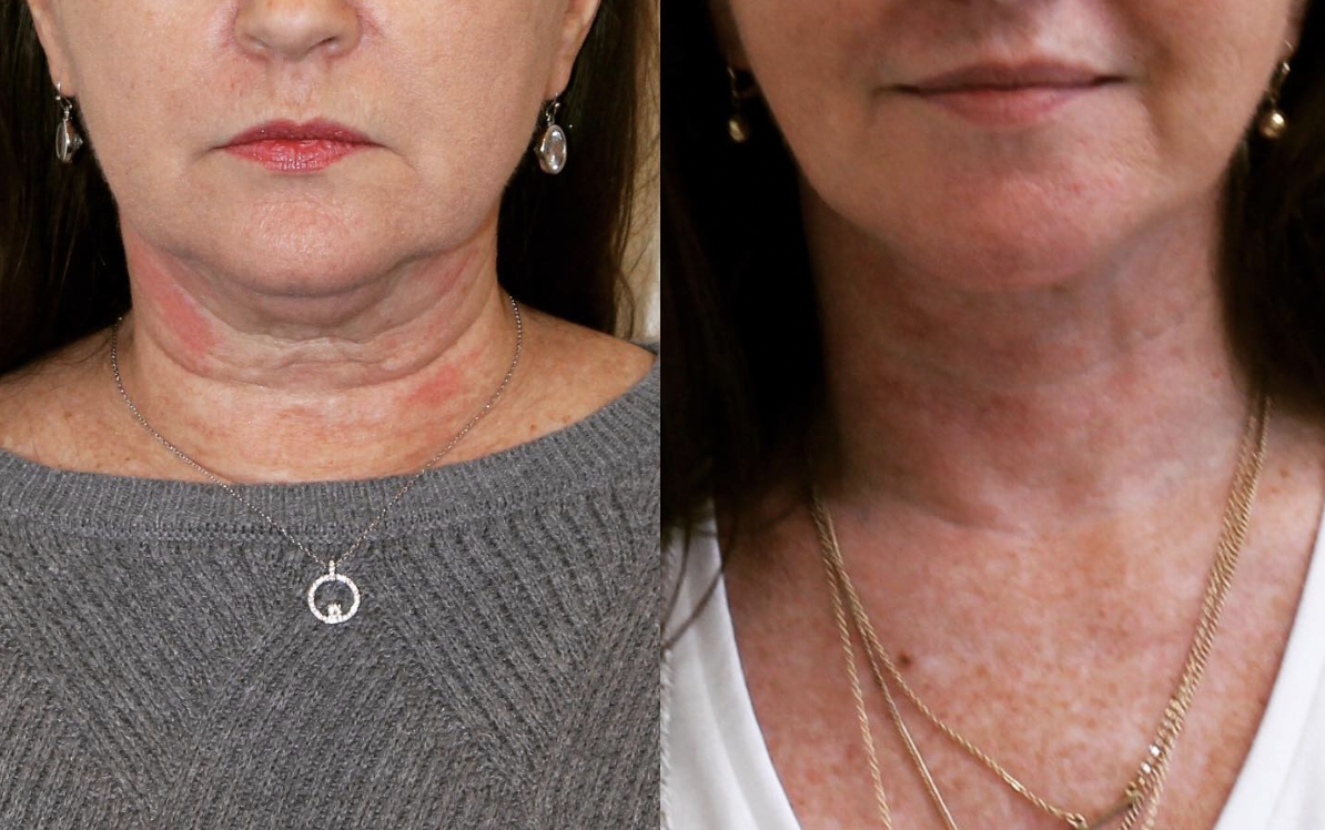 FACELIFT1 Plastic Surgery and Medical Spa in Norwich, CT