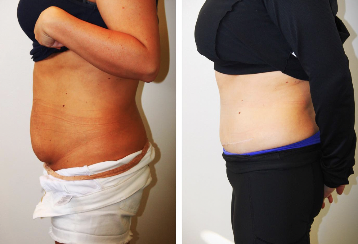 Tummy Tuck Plastic Surgery and Medical Spa in Norwich, CT