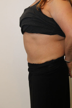 Liposuction Before and After Pictures Norwich, CT