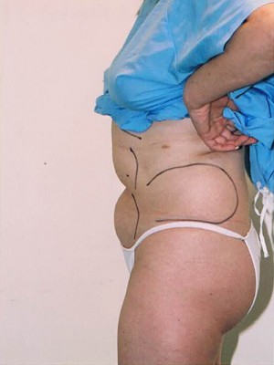 Liposuction Before and After Pictures Norwich, CT