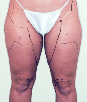 Liposuction Before and After Pictures Norwich, CT