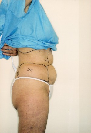 Liposuction Before and After Pictures Norwich, CT