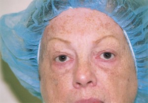Blepharoplasty Before and After Pictures Norwich, CT
