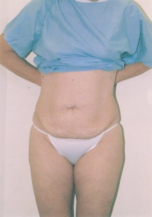 Tummy Tuck Before and After Pictures Norwich, CT