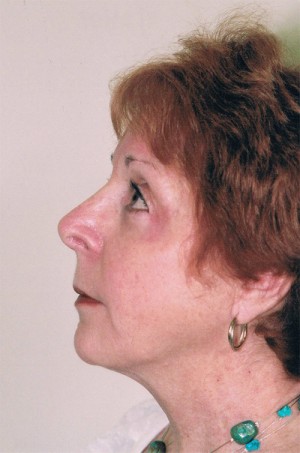 Rhinoplasty Before and After Pictures Norwich, CT