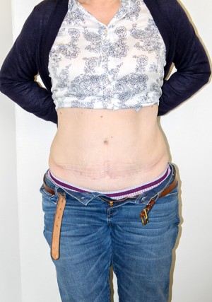 Tummy Tuck Before and After Pictures Norwich, CT