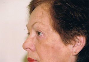 Blepharoplasty Before and After Pictures Norwich, CT