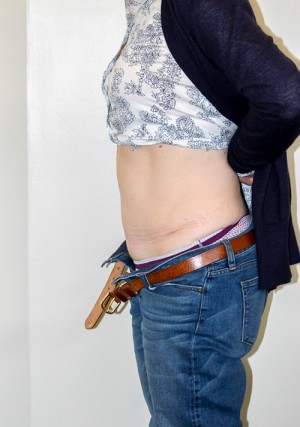 Tummy Tuck Before and After Pictures Norwich, CT