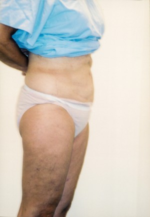 Liposuction Before and After Pictures Norwich, CT