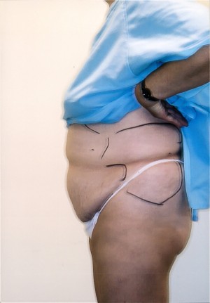 Liposuction Before and After Pictures Norwich, CT