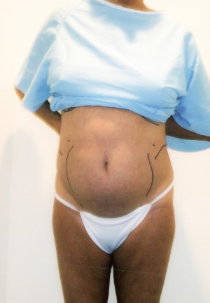 Liposuction Before and After Pictures Norwich, CT