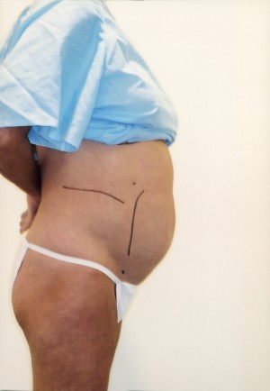 Liposuction Before and After Pictures Norwich, CT