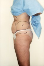 Liposuction Before and After Pictures Norwich, CT