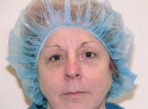 Blepharoplasty Before and After Pictures Norwich, CT