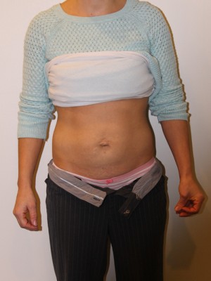 Tummy Tuck Before and After Pictures Norwich, CT
