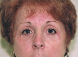 Blepharoplasty Before and After Pictures Norwich, CT