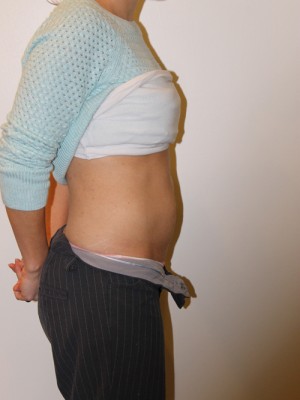 Tummy Tuck Before and After Pictures Norwich, CT