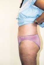 Liposuction Before and After Pictures Norwich, CT