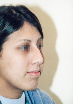 Rhinoplasty Before and After Pictures Norwich, CT