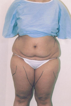 Tummy Tuck Before and After Pictures Norwich, CT