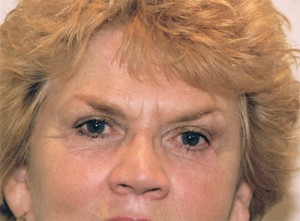 Blepharoplasty Before and After Pictures Norwich, CT