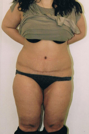 Tummy Tuck Before and After Pictures Norwich, CT