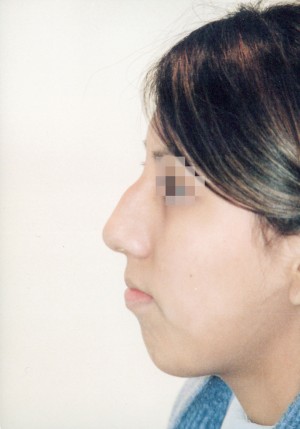Rhinoplasty Before and After Pictures Norwich, CT
