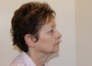 Blepharoplasty Before and After Pictures Norwich, CT