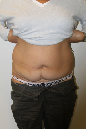 Liposuction Before and After Pictures Norwich, CT