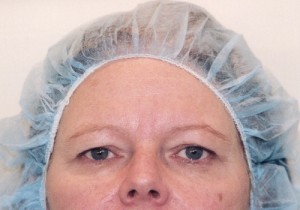 Blepharoplasty Before and After Pictures Norwich, CT