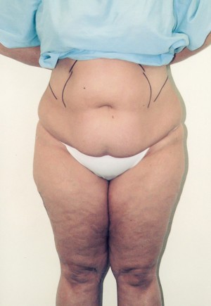 Tummy Tuck Before and After Pictures Norwich, CT