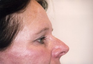 Blepharoplasty Before and After Pictures Norwich, CT