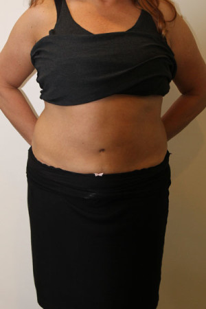 Liposuction Before and After Pictures Norwich, CT