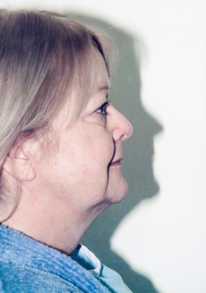 Facelift Before and After Pictures Norwich, CT