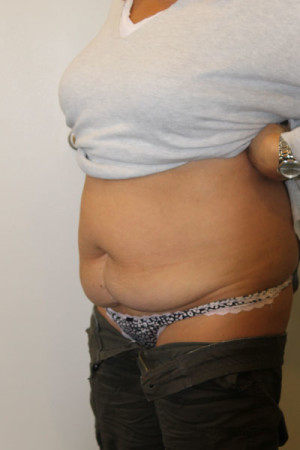 Liposuction Before and After Pictures Norwich, CT