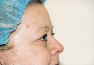 Blepharoplasty Before and After Pictures Norwich, CT