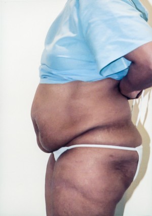 Tummy Tuck Before and After Pictures Norwich, CT