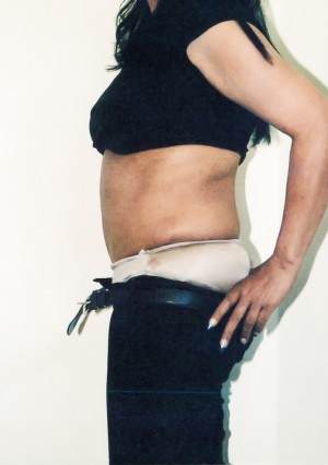 Tummy Tuck Before and After Pictures Norwich, CT