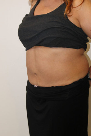 Liposuction Before and After Pictures Norwich, CT