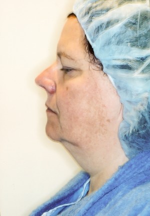 Facelift Before and After Pictures Norwich, CT