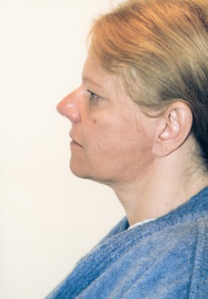 Facelift Before and After Pictures Norwich, CT