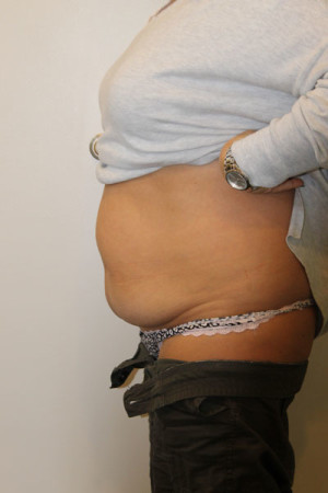 Liposuction Before and After Pictures Norwich, CT