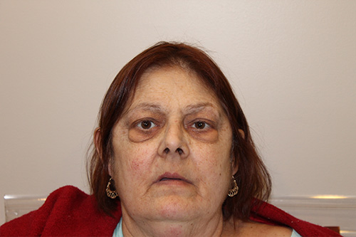 Blepharoplasty Before and After Pictures in Norwich, CT