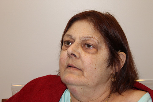 Blepharoplasty Before and After Pictures in Norwich, CT