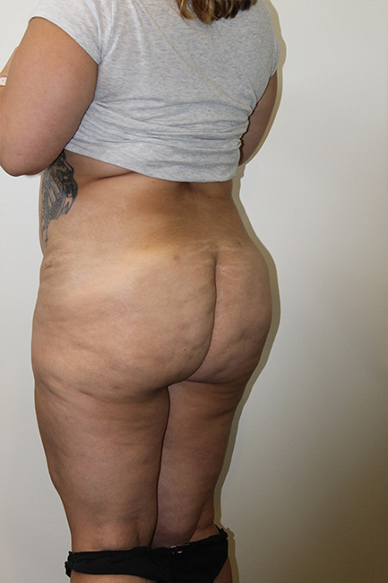 Brazilian Butt Lift Before And After Pictures In Norwich, CT