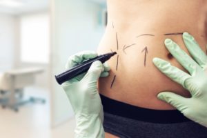 Plastic Surgery (Cosmetic Surgery) in Norwich, CT