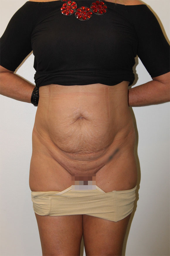 Tummy Tuck Before And After Pictures In Norwich, CT