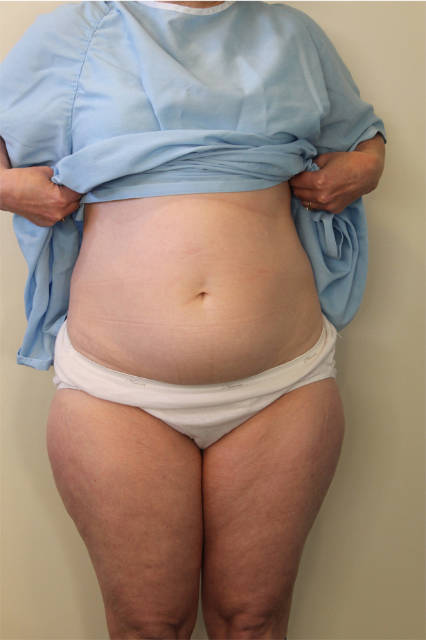 Liposuction Before and After Pictures in Norwich, CT