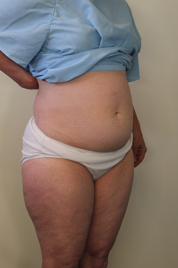 Liposuction Before and After Pictures in Norwich, CT