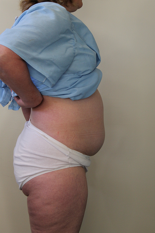 Liposuction Before and After Pictures in Norwich, CT